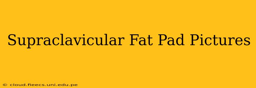 Supraclavicular Fat Pad Pictures